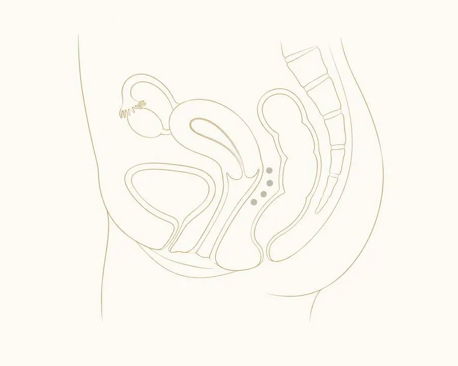 Ilustração da pelve feminina em corte sagital, com marcação do compartimento posterior entre o útero e o reto